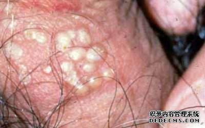 男性生殖器疱疹症状